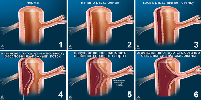 Покалывание в верхней части грудной клетки