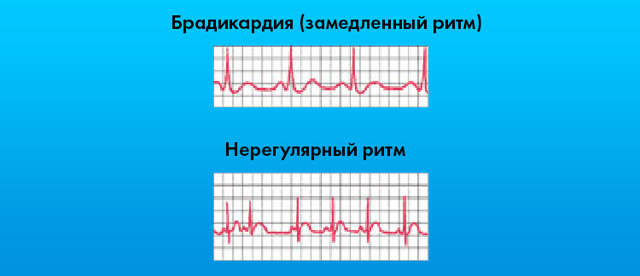 Картинки ЭКГ при нарушениях ритма