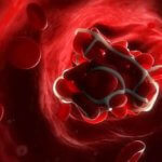 Тромб в сонной артерии: лечение, симптомы и удаление