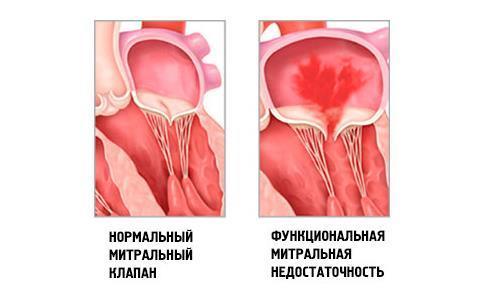 Фиброз створок митрального клапана