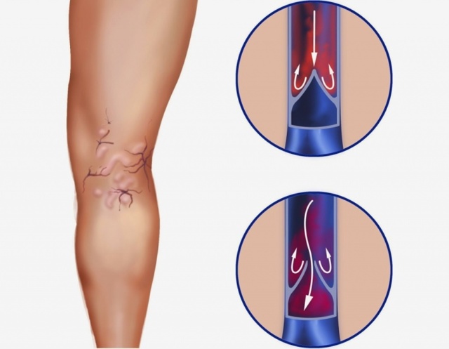 Флеболиты в малом тазу у мужчин - Все про холестерин
