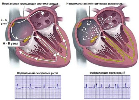 Пароксизмальная мерцательная аритмия: причины, лечение