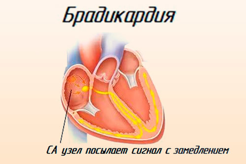 Что принимать при брадикардии