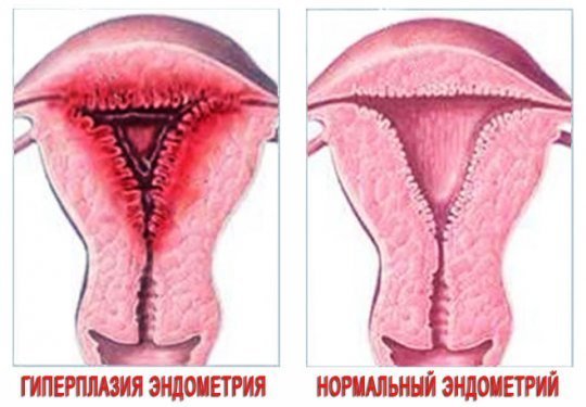 Месячные идут со сгустками крови и кусками — причины