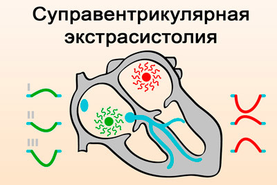 Желудочковые экстрасистолы норма