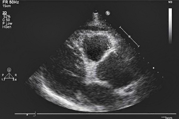 Эхо КГ сердца что это такое, как делают