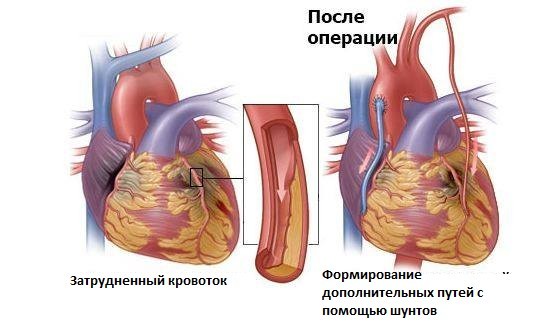 Инвалидность при ИБС - советы адвокатов и юристов