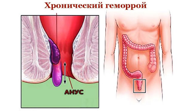 Профилактика геморроя у мужчин в домашних условиях: диета и упражнения