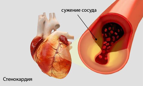 Что делать, если беспокоит жжение в области сердца