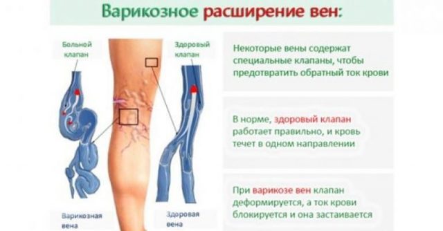 Симптомы варикозного расширения вен на ногах, степени и стадии варикоза