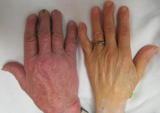 Повышенный билирубин – причины и симптомы билирубина, диагностика, лечение и профилактика