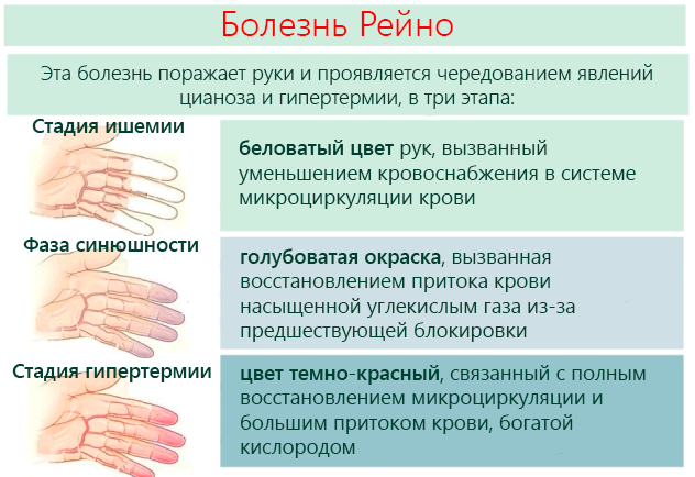 Болезнь Рейно – симптомы у женщин. Болезнь и синдром Рейно – причины, диагностика, лечение, прогноз