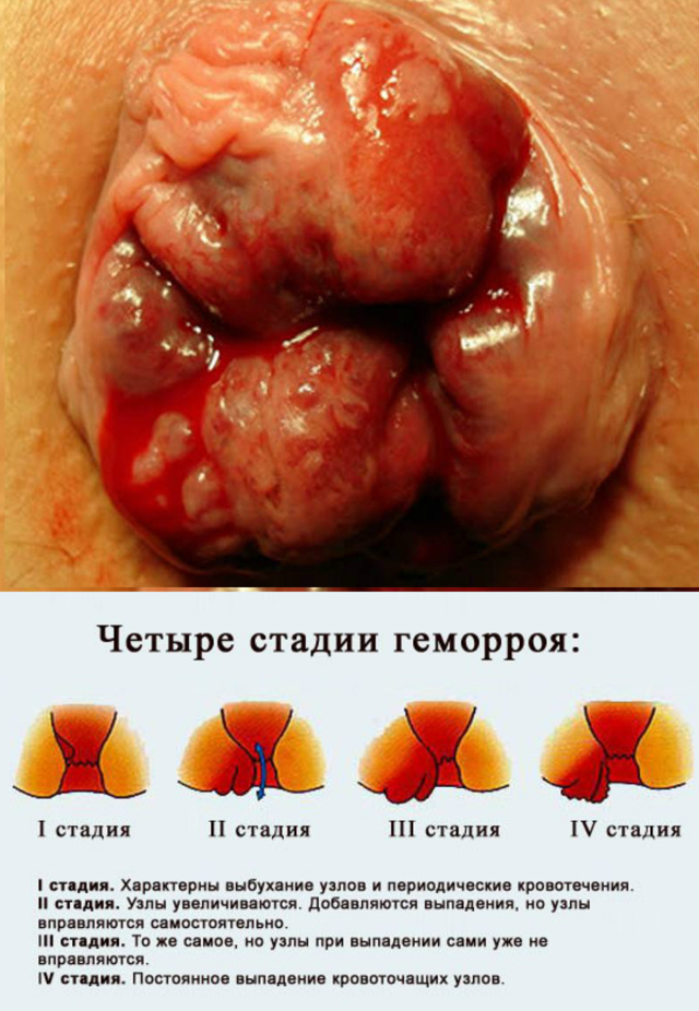 Можно ли плавать в бассейне при геморрое — Сайт о геморрое