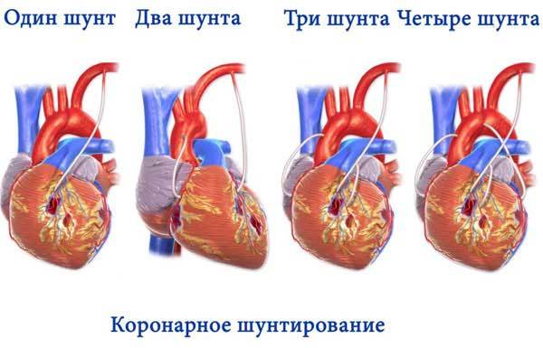 Заболевание бычье сердце