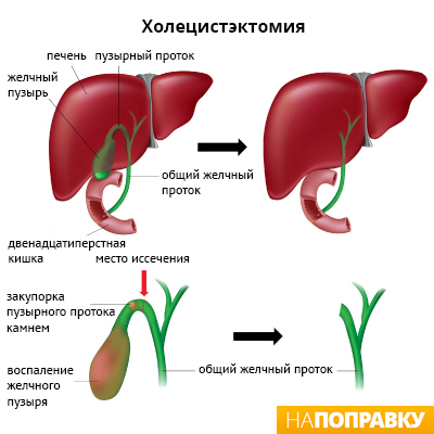 Диагностика и профилактика холецистита