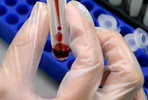 Лейкоцитарная формула в норме, причины отклонения показателей и возможные заболевания