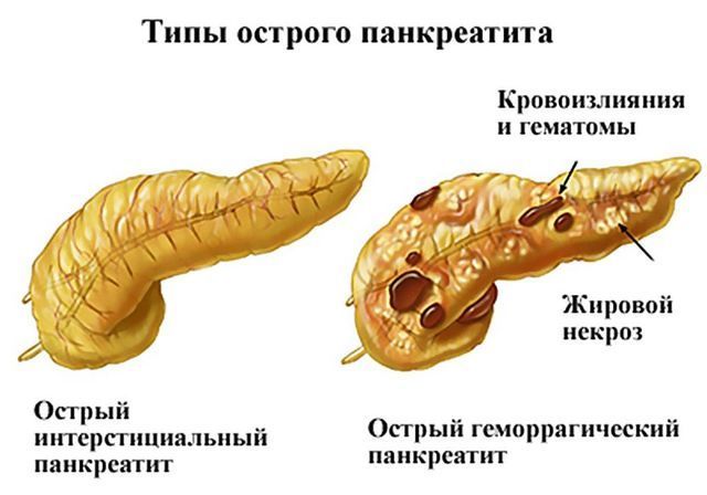 Что такое геморрагический панкреонекроз