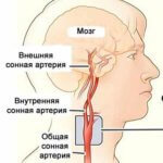 Тромб в сонной артерии: лечение, симптомы и удаление