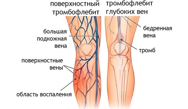 Тромб в легких: тромбоз легочной вены – симптомы и лечение
