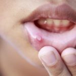 Афтозный стоматит у детей и взрослых: фото, лечение