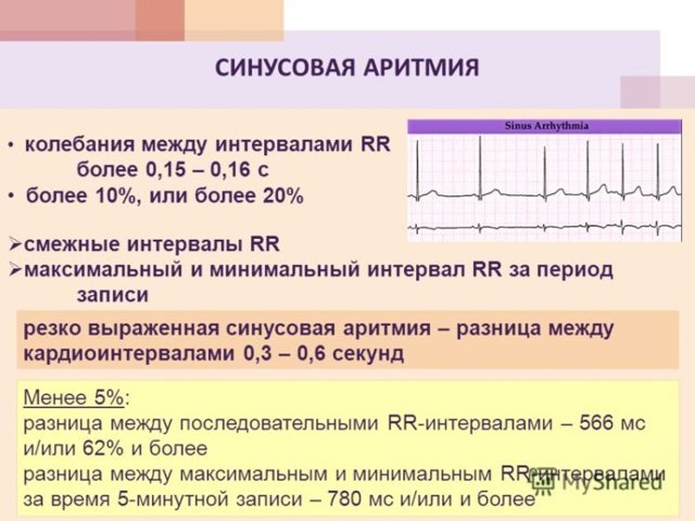 Регулярный и нерегулярный синусовый ритм сердца