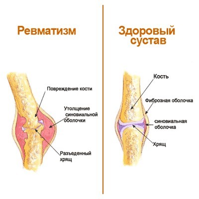Ревматизм - причины, признаки, симптомы и лечение