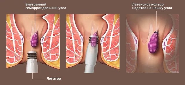 Что такое лигирование внутреннего геморроидального узла — Сайт о геморрое