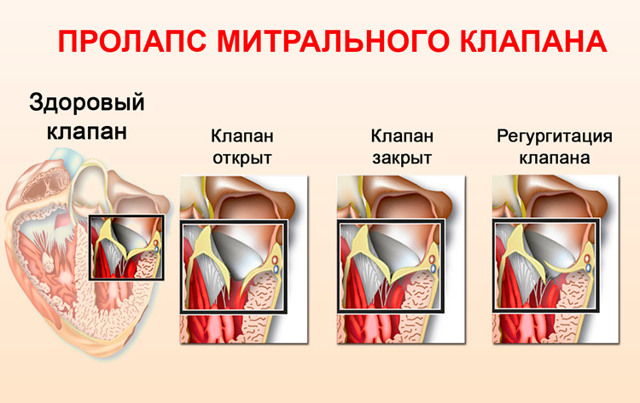 ПМК 1 степени - симптомы, лечение, диагностика