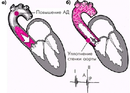 Уплотнение аорты – причины, симптомы, осложнения и лечение уплотнения аорты