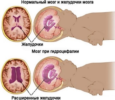 Могут ли желудочки головного мозга уменьшится сами. Расширение боковых желудочков головного мозга