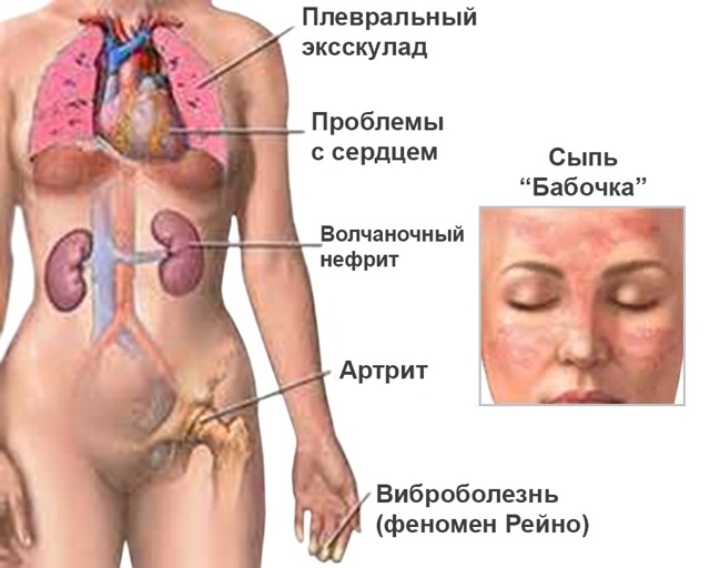 Красная волчанка - что это за болезнь? (с фото)