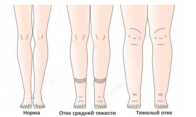 Тромбоз глубоких вен нижних конечностей лечение народными средствами