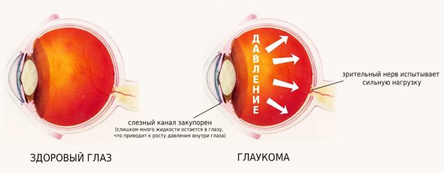 Дорзопт глазные капли: инструкция, цена, аналоги, советы по применению и отзывы
