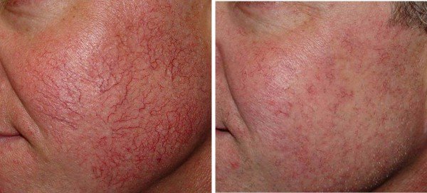 Как убрать красные сосуды на лице в домашних условиях