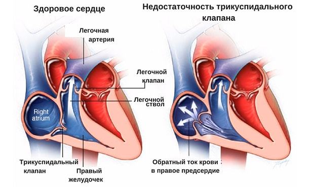 Гипертрофия правого предсердия на ЭКГ: симптомы перегрузки сердца