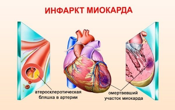 Абдоминальная форма инфаркта миокарда: симптомы