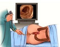 Чем лечить геморрой у женщин при симптомах заболевания