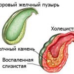 Боль под правой лопаткой сзади со спины (колющая, резкая, тупая): причины и лечение
