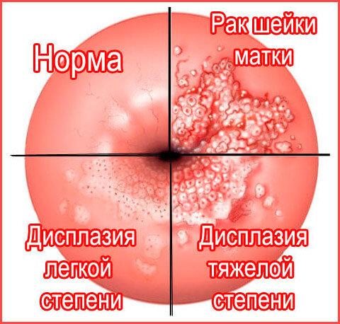 Вирус папилломы человека у женщин симптомы фото