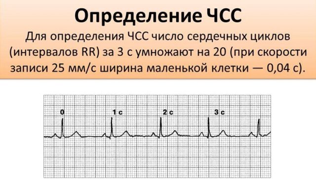 Позиция сердца вертикальная: как выглядит, признаки заболевания, расшифровка, что это