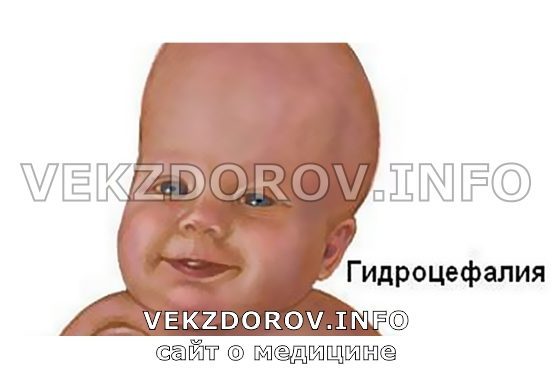 Асимметрия боковых желудочков мозга у детей и взрослых