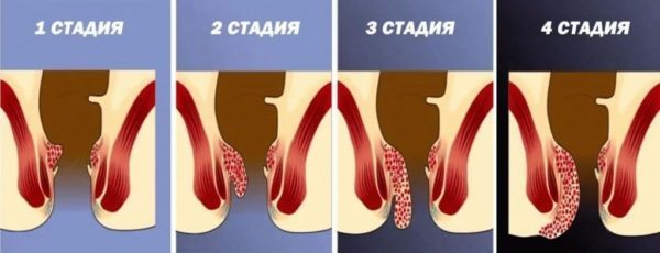 Как вылечить геморрой раз и навсегда - Лечение геморроя
