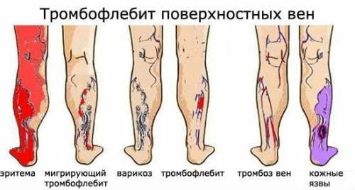 Болезни сосудов ног: причины появления и методы лечения