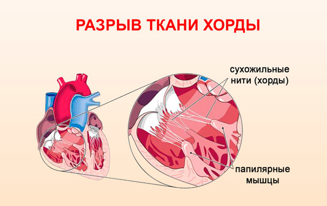 ПМК 1 степени - симптомы, лечение, диагностика