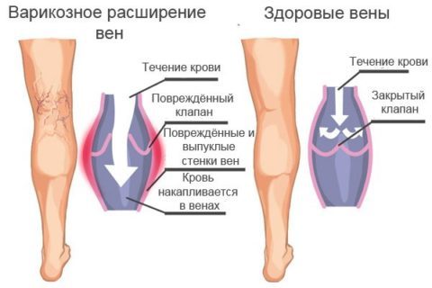 Чем грозит варикозное расширение вен на ногах на сайте варикоз