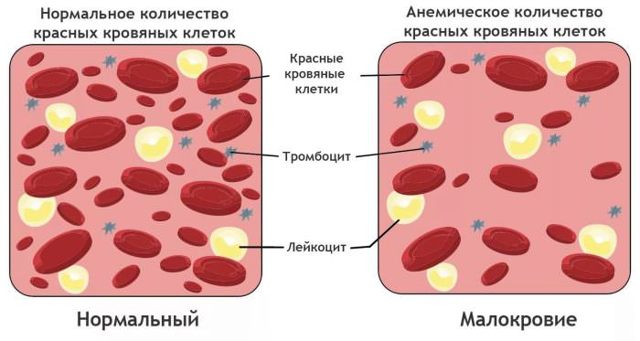 Острый миелоидный лейкоз - причины, симптомы, диагностика и лечение, прогноз
