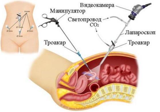 Месячные идут сгустками – причины и лечение патологии