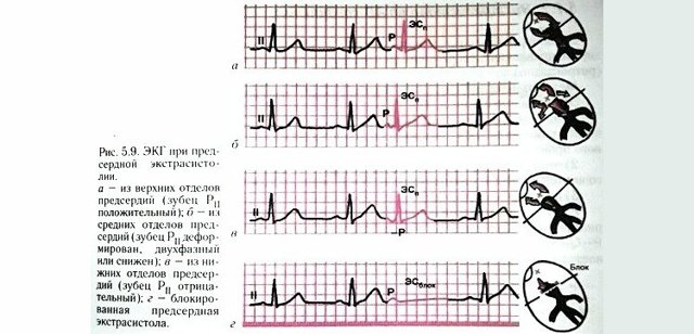 Предсердная экстрасистолия: какие симптомы, причины и лечение