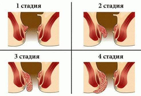 Роды с геморроем - можно ли? и как рожать с геморроем, наши советы