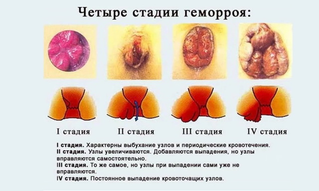 Узлы в прямой кишке - Геморроидальные узлы
